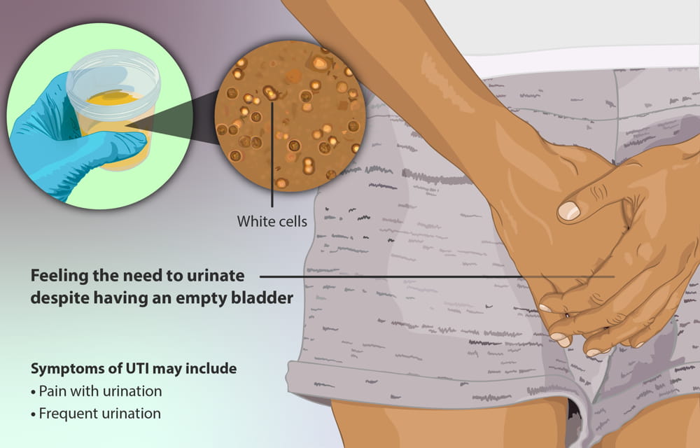 Urinary Tract Infection