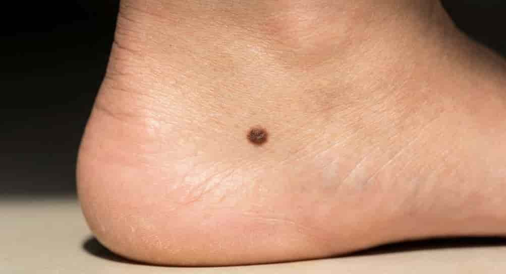 Spiritual Meanings of Moles on the Feet