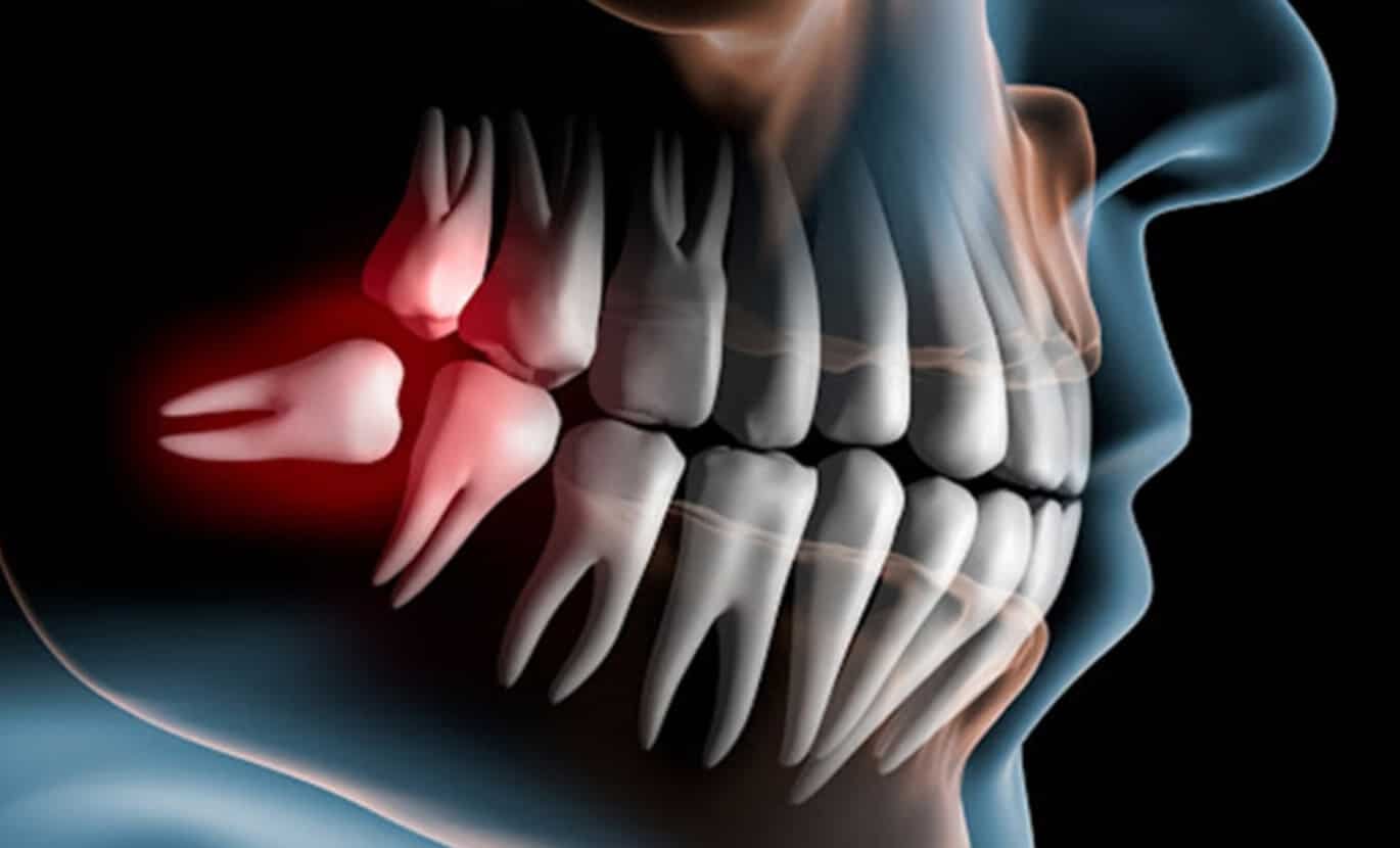 Spiritual Meanings of Wisdom Teeth