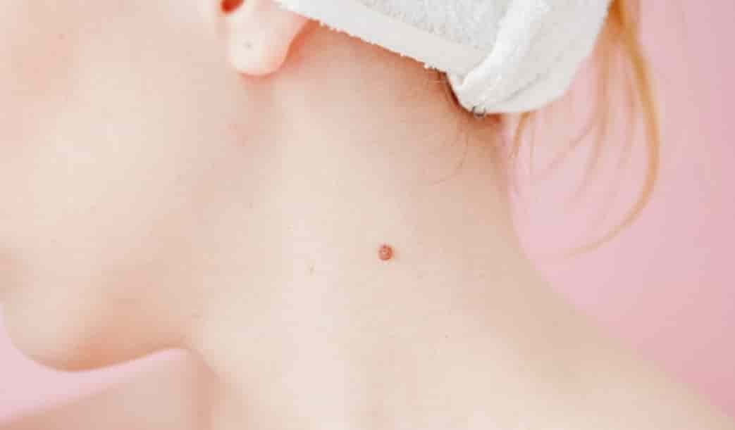 Spiritual Meanings of a Mole on the Neck