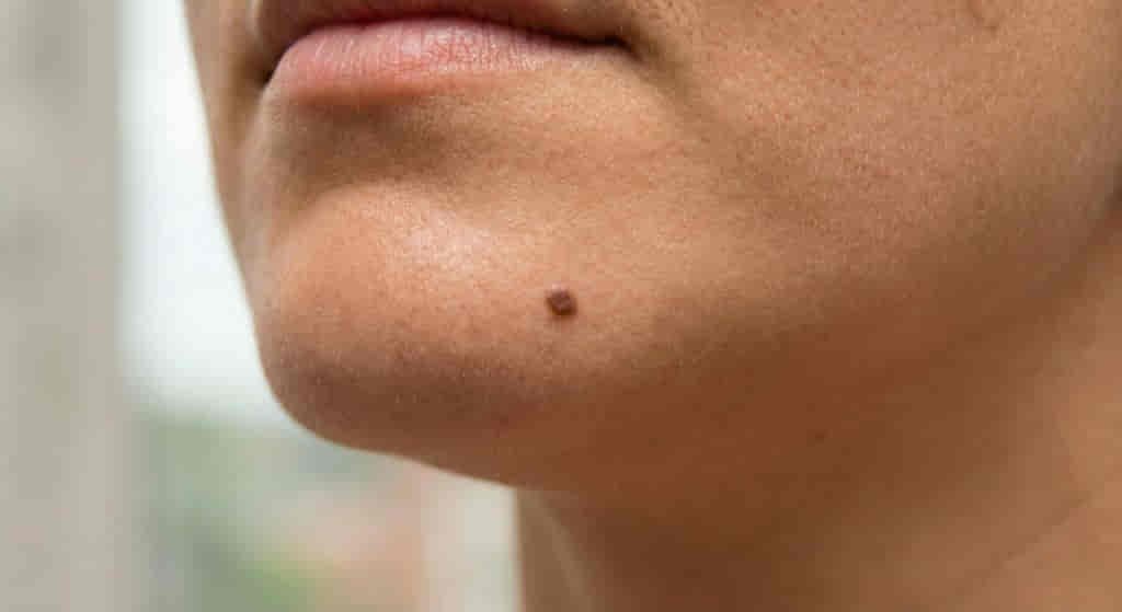 Spiritual-Meanings-of-a-Mole-on-the-Chin